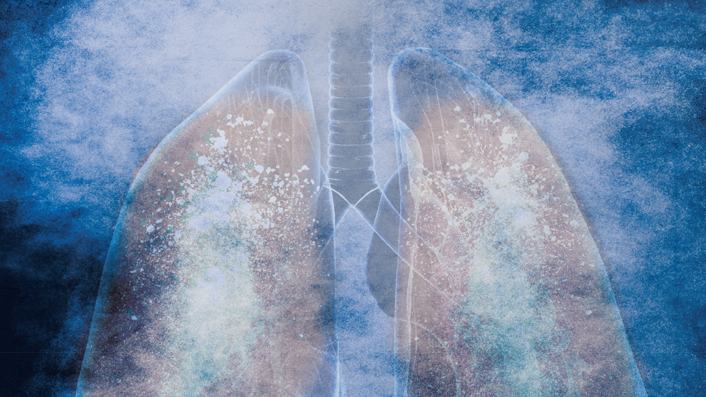 An artistic illustration of human lungs surrounded by a blue smoky background.